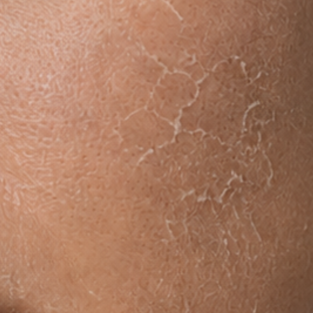 Dry & Dehydrated Skin